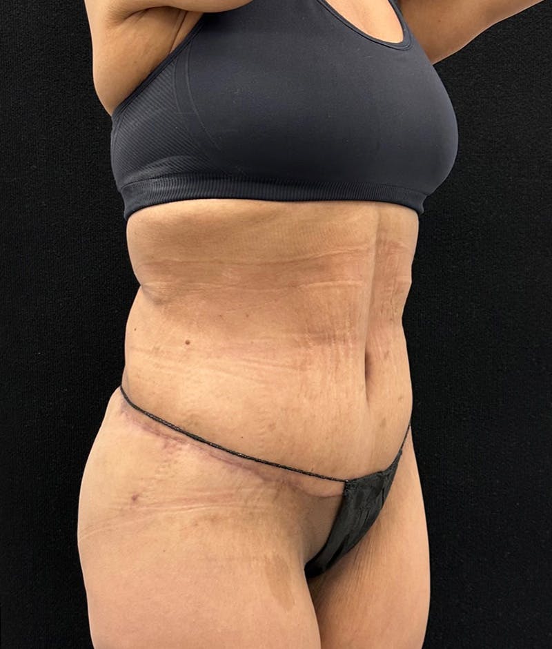 Lower Body Lift Before & After Gallery - Patient 119584 - Image 4