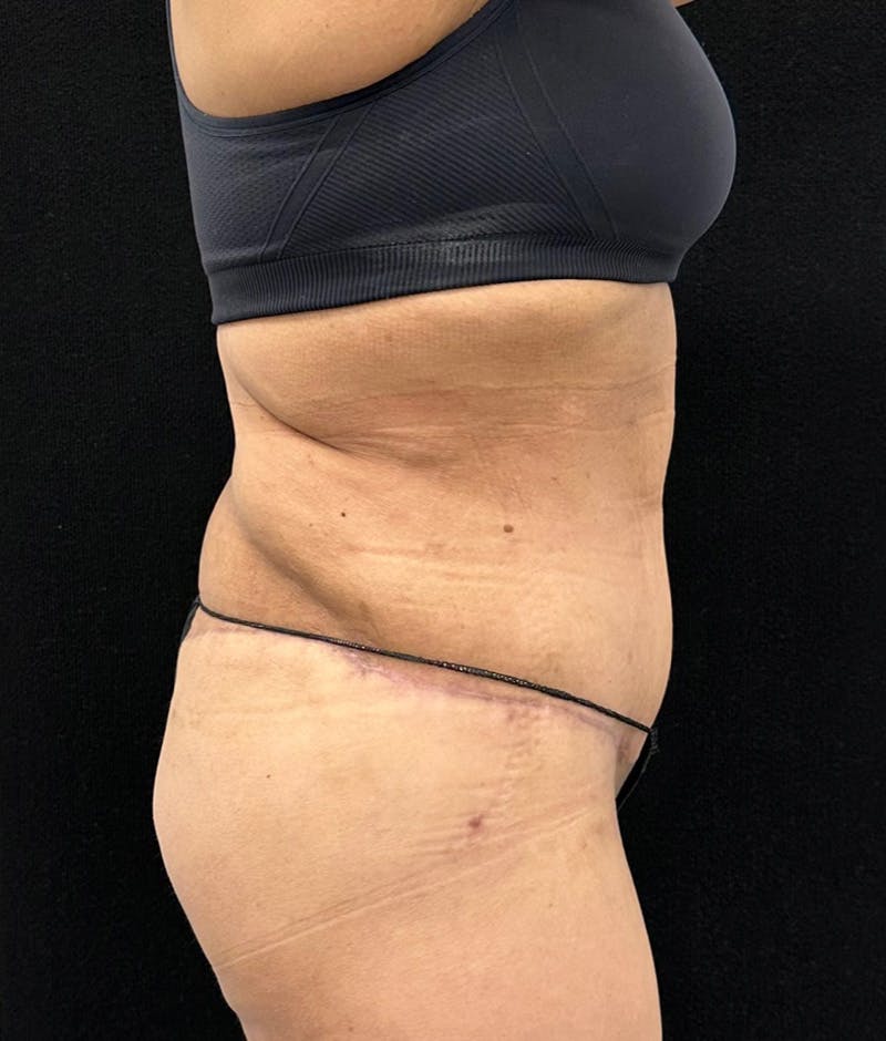 Lower Body Lift Before & After Gallery - Patient 119584 - Image 6