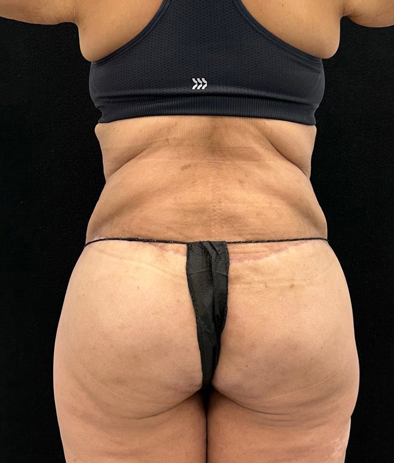 Lower Body Lift Before & After Gallery - Patient 119584 - Image 8