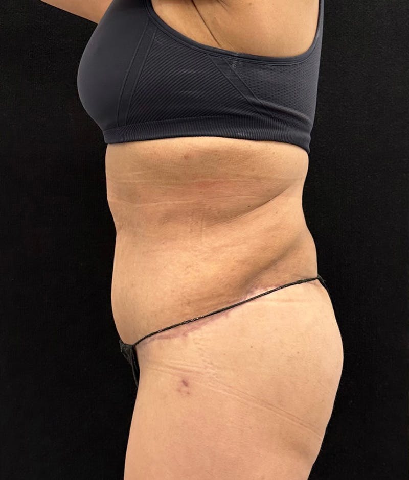 Lower Body Lift Before & After Gallery - Patient 119584 - Image 12