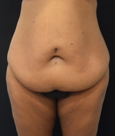 Lower Body Lift Before & After Gallery - Patient 857312 - Image 1