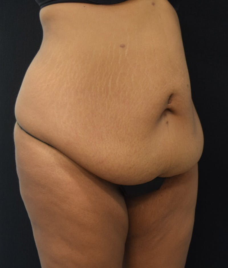 Lower Body Lift Before & After Gallery - Patient 857312 - Image 3