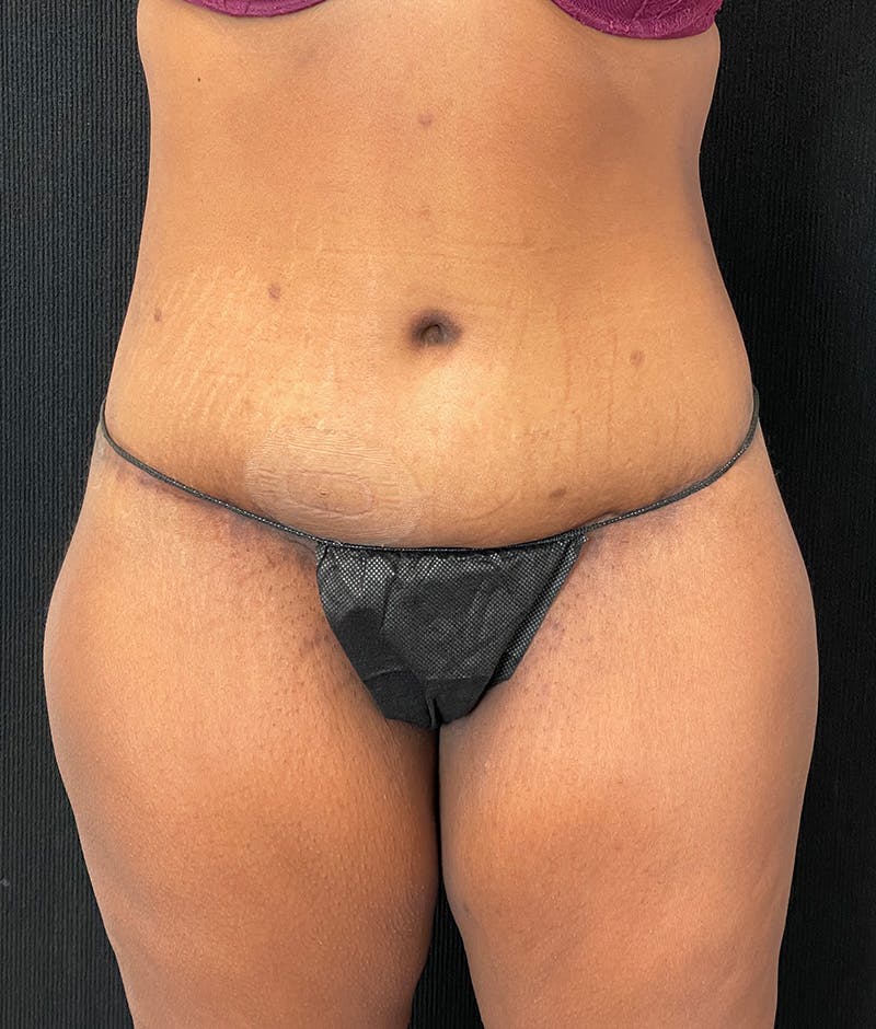Lower Body Lift Before & After Gallery - Patient 857312 - Image 2