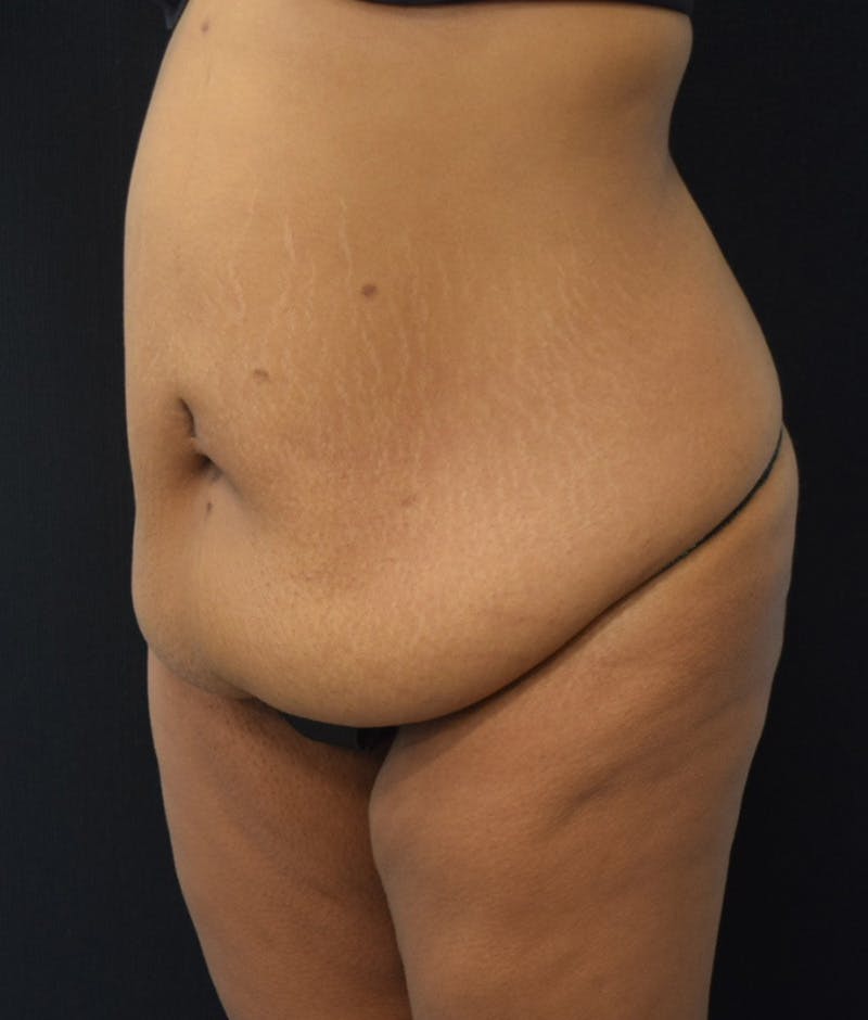 Lower Body Lift Before & After Gallery - Patient 857312 - Image 7