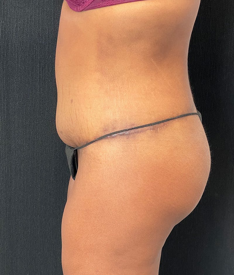 Lower Body Lift Before & After Gallery - Patient 857312 - Image 10