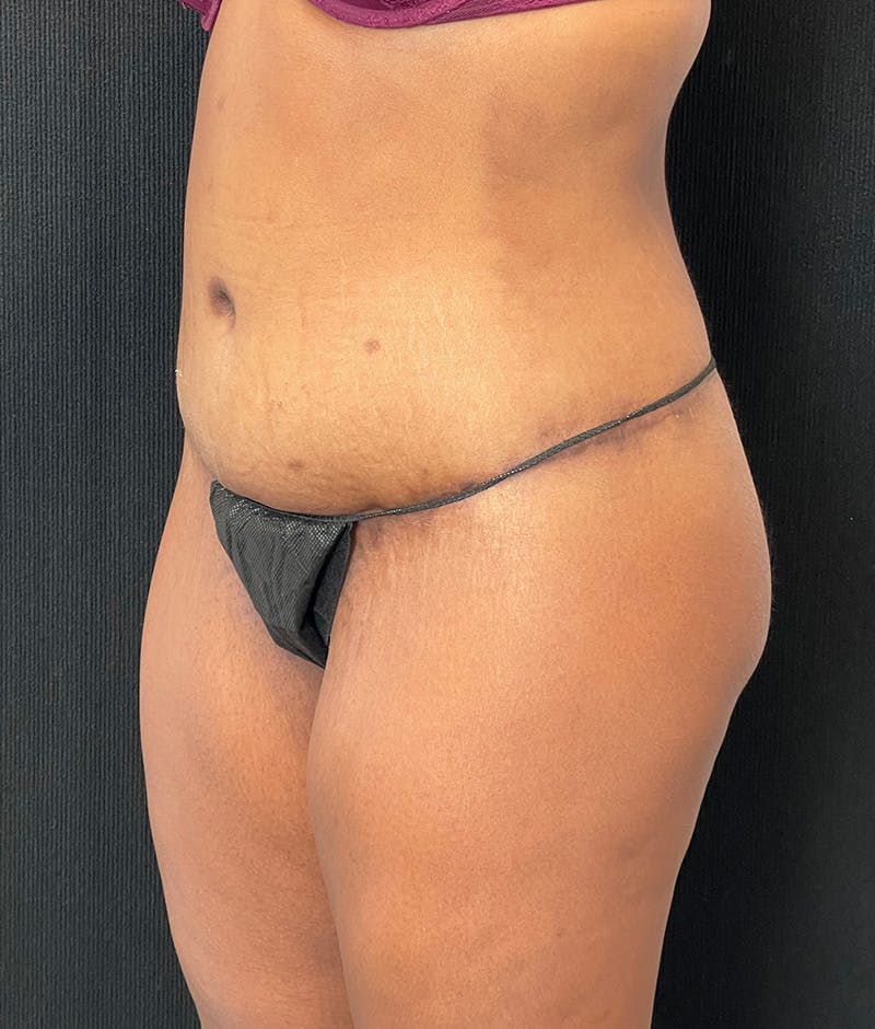 Lower Body Lift Before & After Gallery - Patient 857312 - Image 8