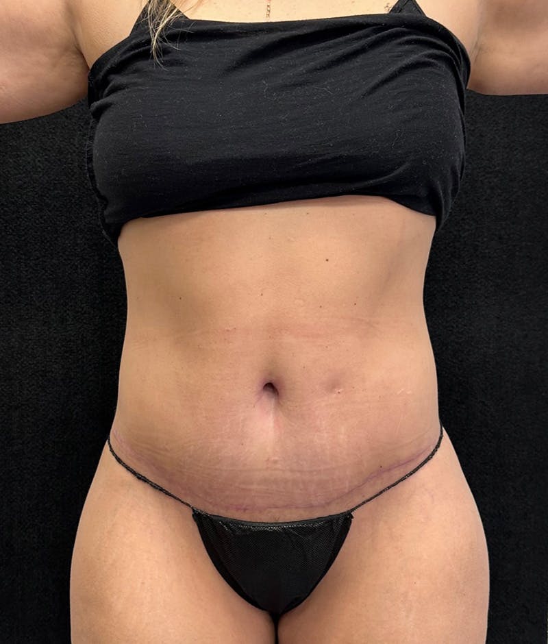 Lower Body Lift Before & After Gallery - Patient 191147 - Image 2