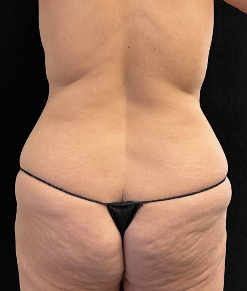 Lower Body Lift Before & After Gallery - Patient 191147 - Image 7
