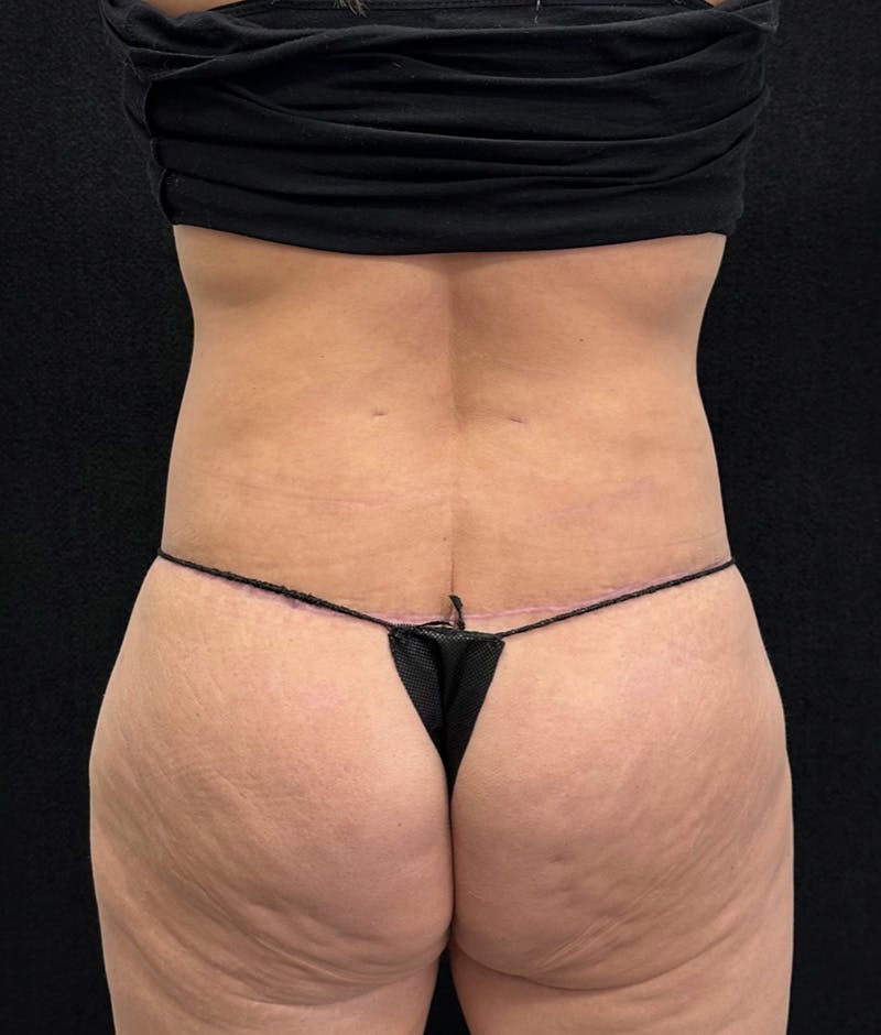 Lower Body Lift Before & After Gallery - Patient 191147 - Image 8