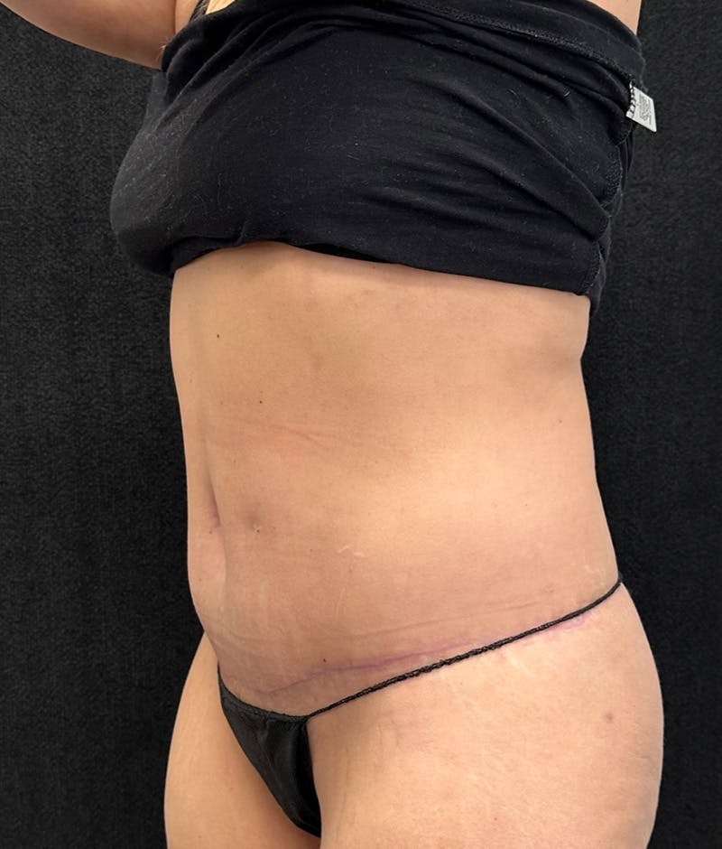 Lower Body Lift Before & After Gallery - Patient 191147 - Image 10