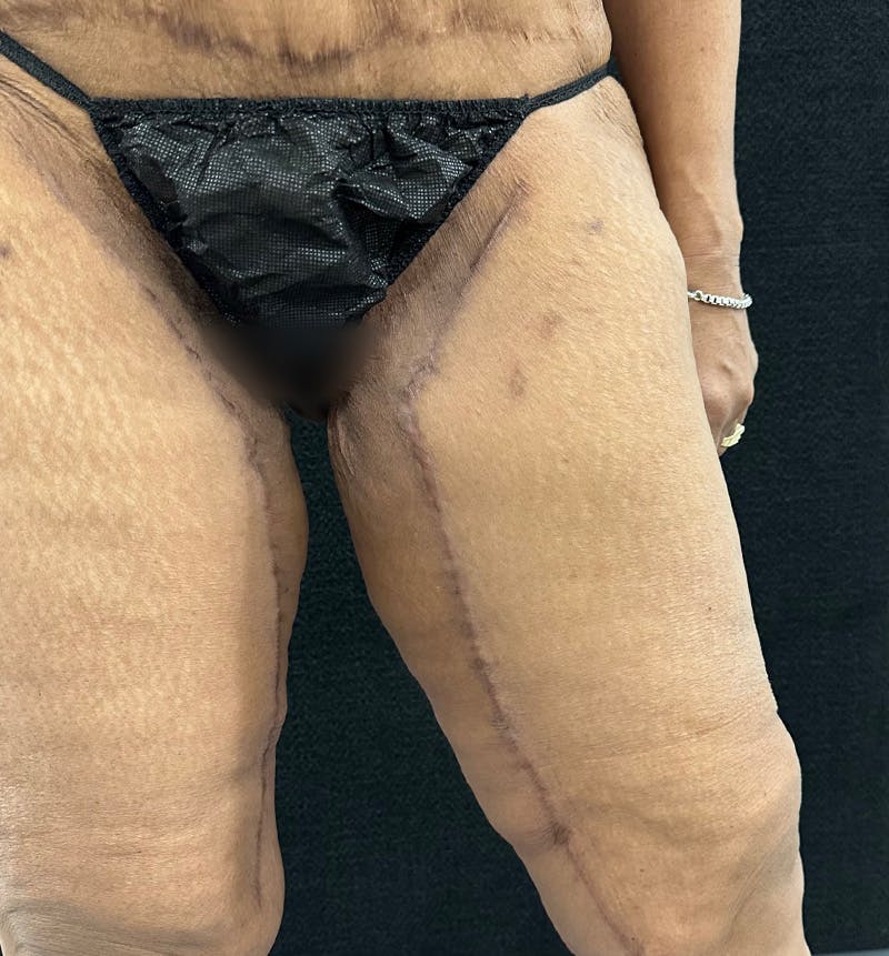 Thigh Lift Before & After Gallery - Patient 149192 - Image 4