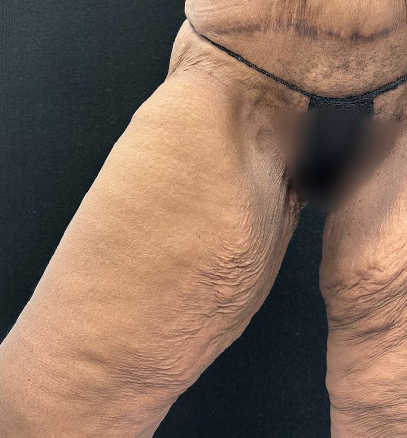Thigh Lift Before & After Gallery - Patient 149192 - Image 5