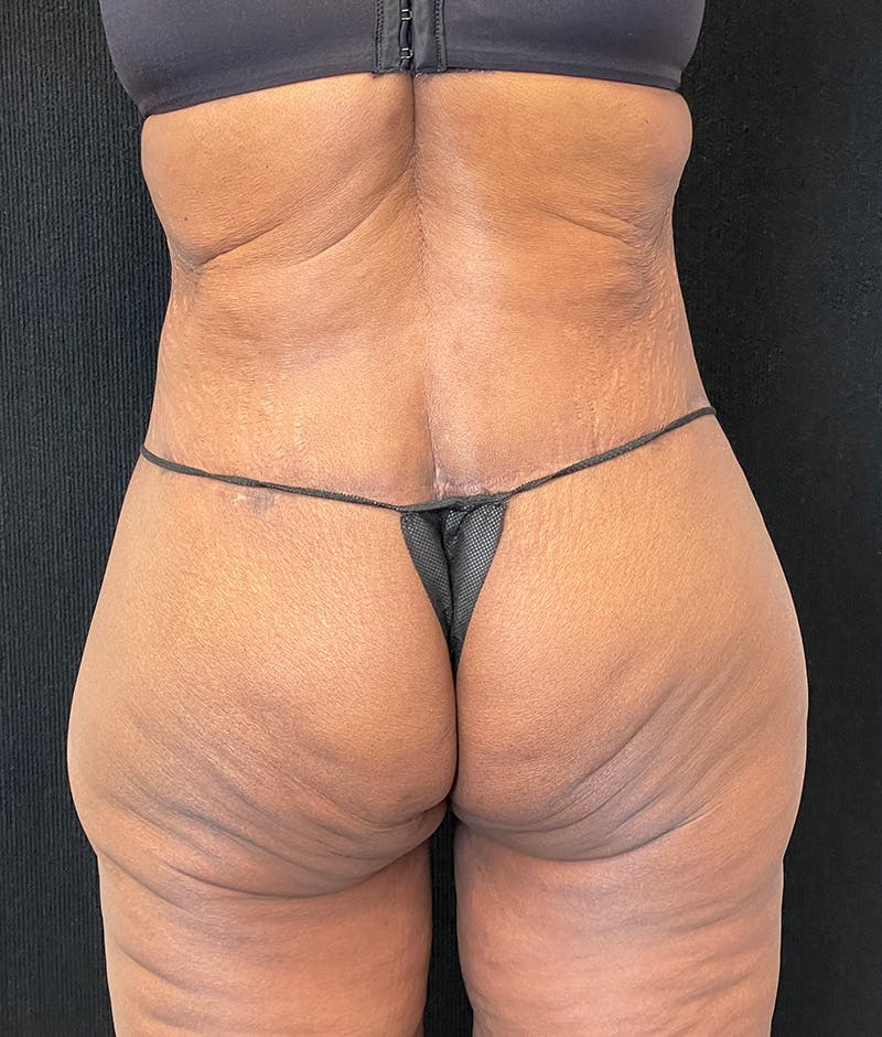Lower Body Lift Before & After Gallery - Patient 276186 - Image 12