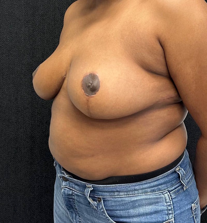 Breast Reduction Before & After Gallery - Patient 207134 - Image 6