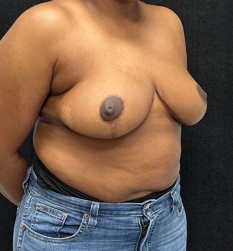 Breast Reduction Before & After Gallery - Patient 207134 - Image 8