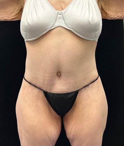 Lower Body Lift Before & After Gallery - Patient 948760 - Image 2