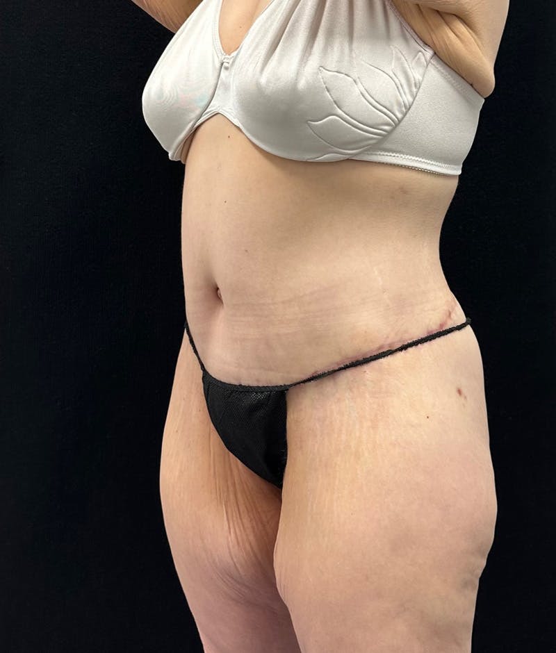 Lower Body Lift Before & After Gallery - Patient 948760 - Image 8