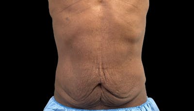 Abdominoplasty Before & After Gallery - Patient 165027 - Image 1