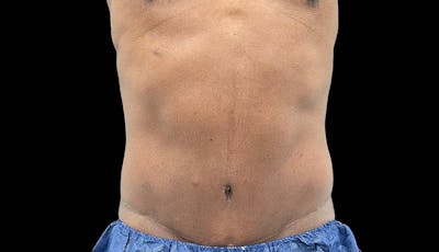 Abdominoplasty Before & After Gallery - Patient 165027 - Image 2
