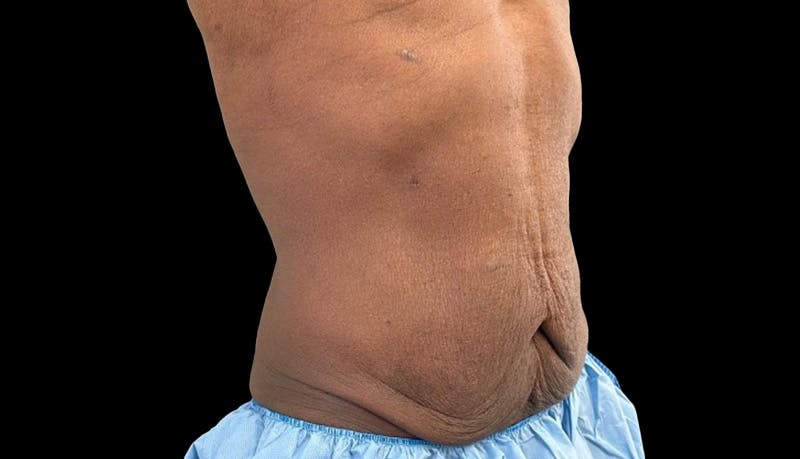 Abdominoplasty Before & After Gallery - Patient 165027 - Image 3