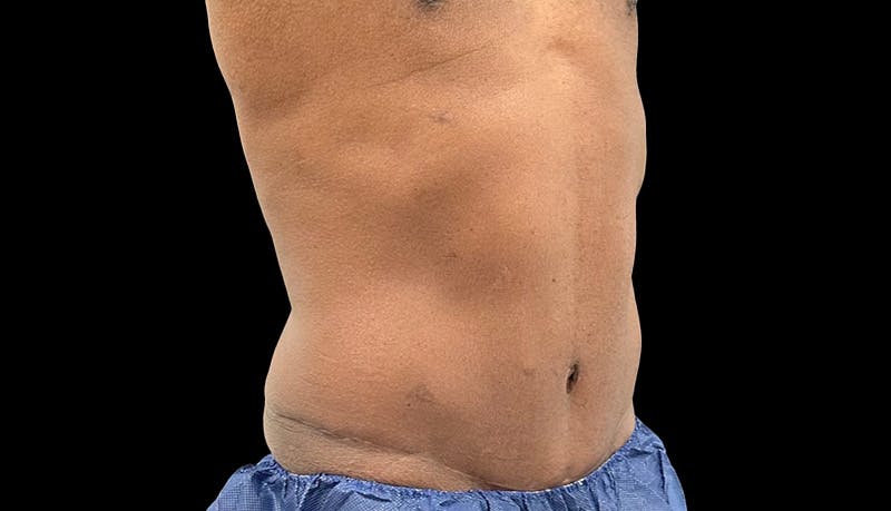 Abdominoplasty Before & After Gallery - Patient 165027 - Image 4