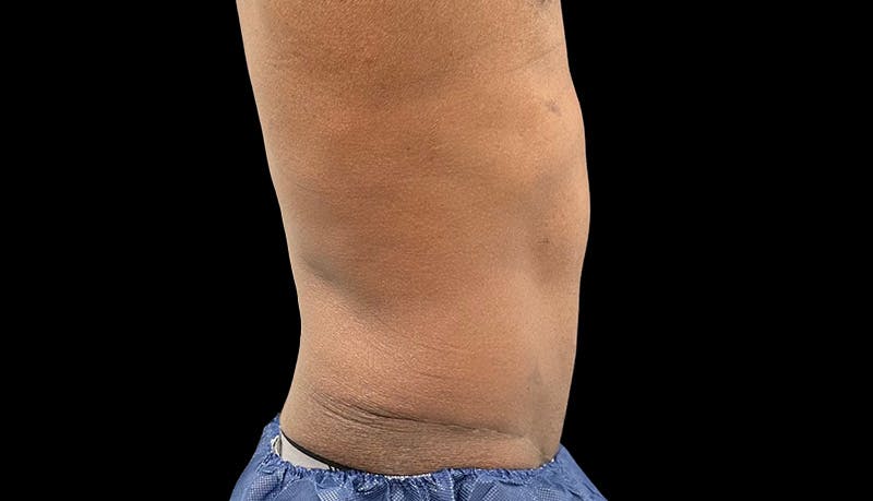Abdominoplasty Before & After Gallery - Patient 165027 - Image 6
