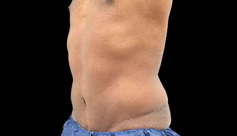 Abdominoplasty Before & After Gallery - Patient 165027 - Image 8