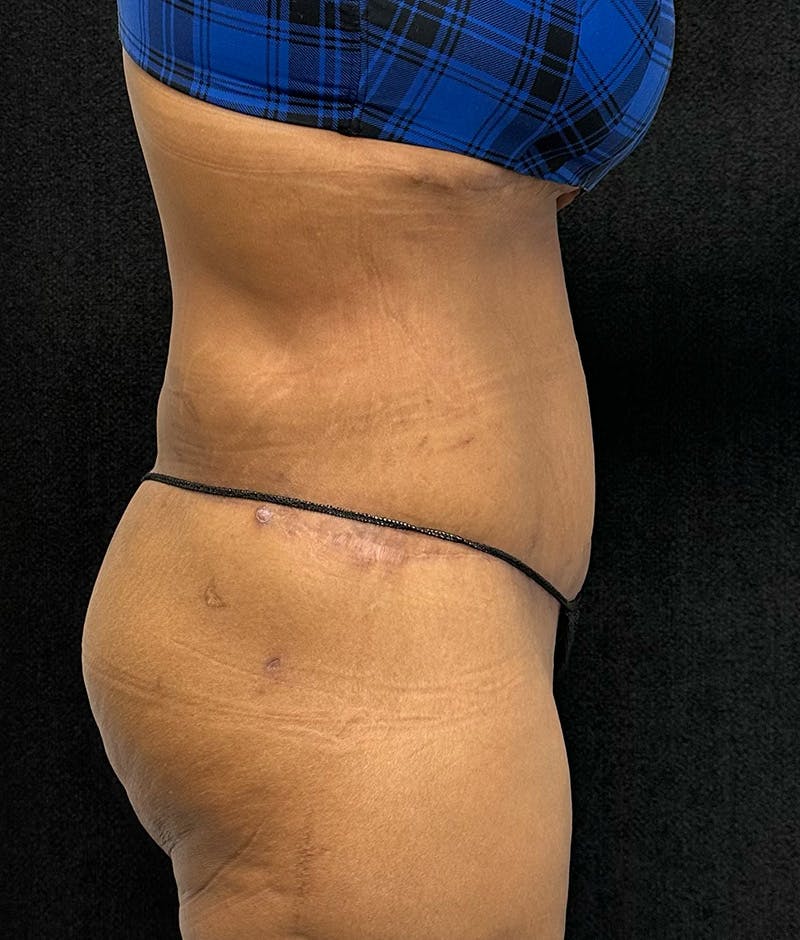 Lower Body Lift Before & After Gallery - Patient 148914 - Image 6