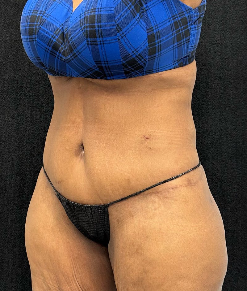 Lower Body Lift Before & After Gallery - Patient 148914 - Image 8