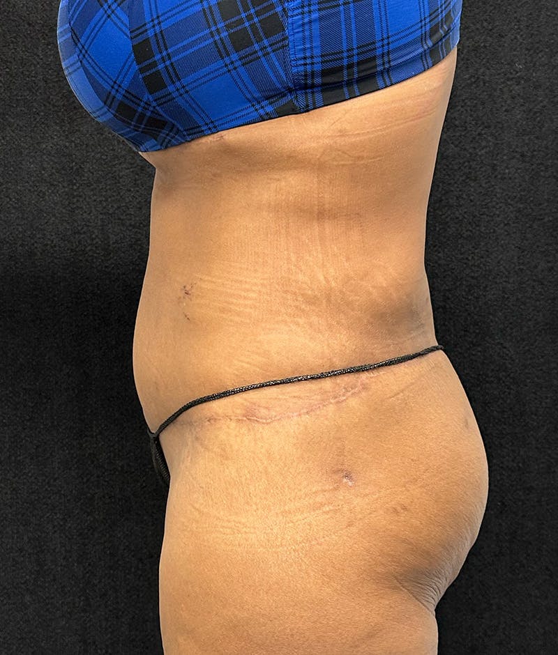 Lower Body Lift Before & After Gallery - Patient 148914 - Image 10