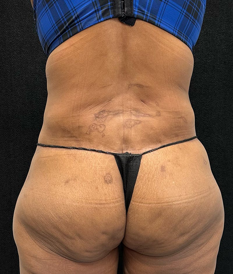 Lower Body Lift Before & After Gallery - Patient 148914 - Image 12