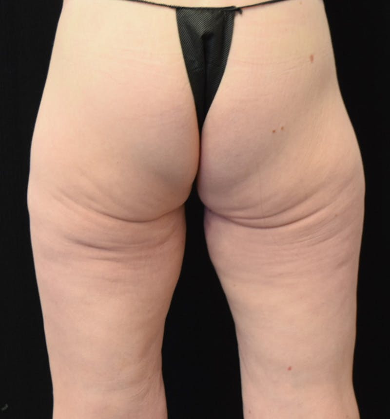 Thigh Lift Before & After Gallery - Patient 312256 - Image 5