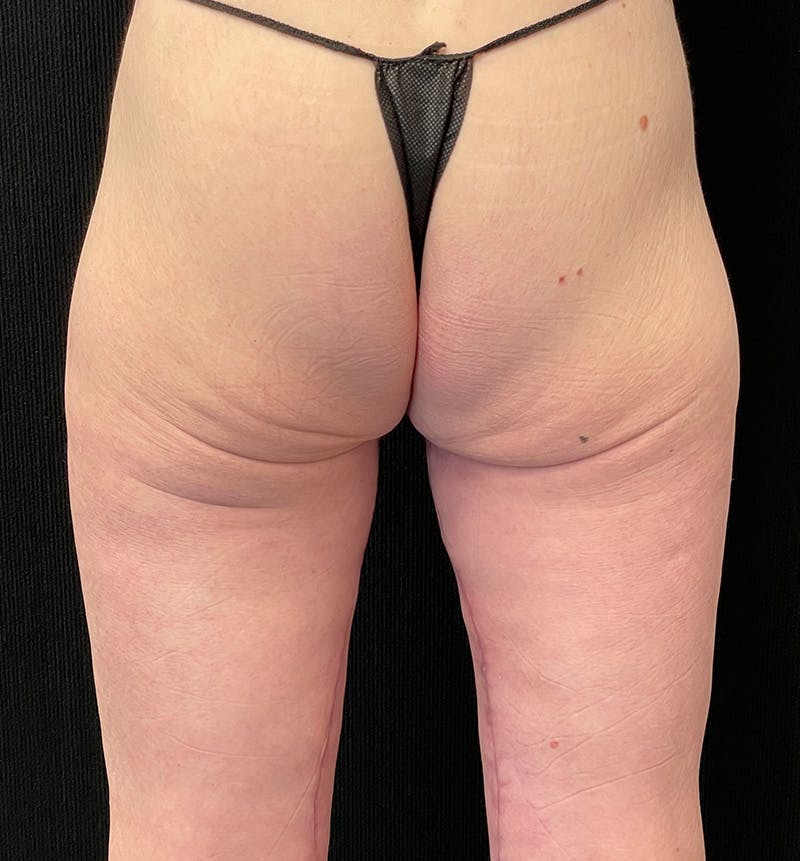 Thigh Lift Before & After Gallery - Patient 312256 - Image 6