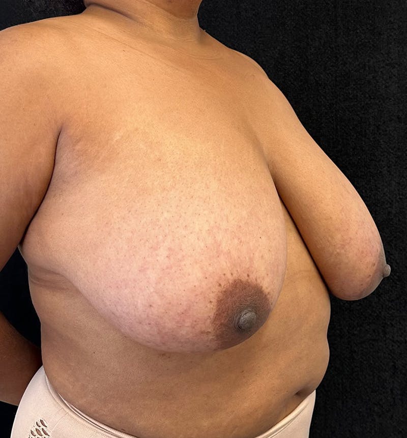 Breast Reduction Before & After Gallery - Patient 319686 - Image 3
