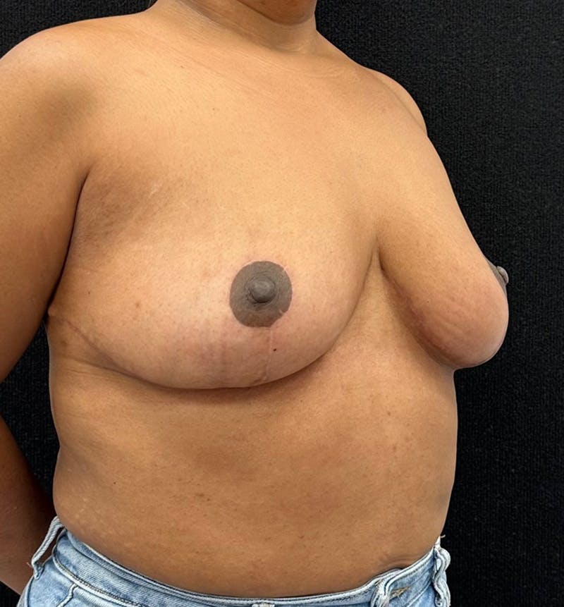 Breast Reduction Before & After Gallery - Patient 319686 - Image 4