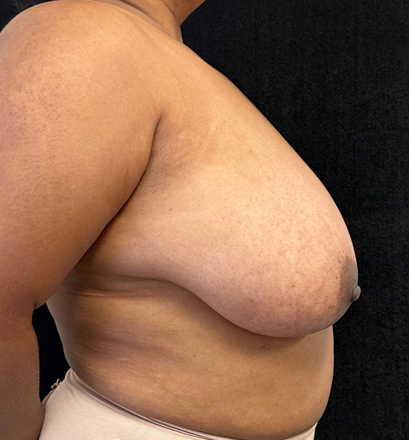 Breast Reduction Before & After Gallery - Patient 319686 - Image 5