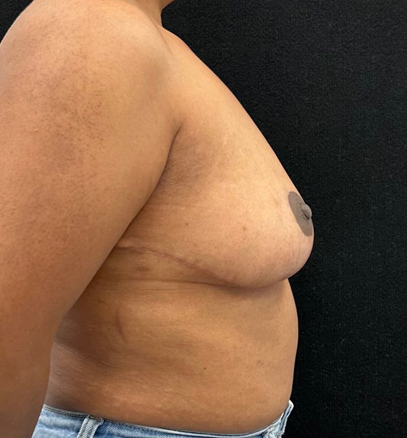 Breast Reduction Before & After Gallery - Patient 319686 - Image 6