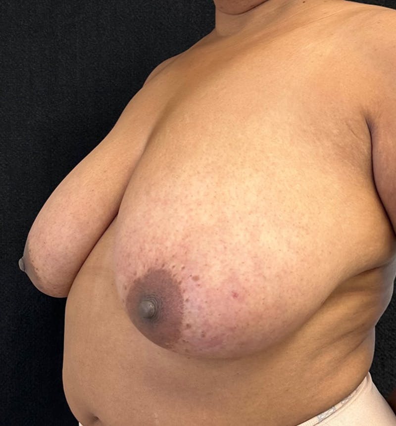 Breast Reduction Before & After Gallery - Patient 319686 - Image 7