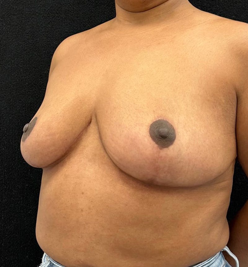 Breast Reduction Before & After Gallery - Patient 319686 - Image 8