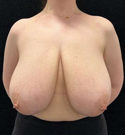 Breast Reduction Before & After Gallery - Patient 392917 - Image 1