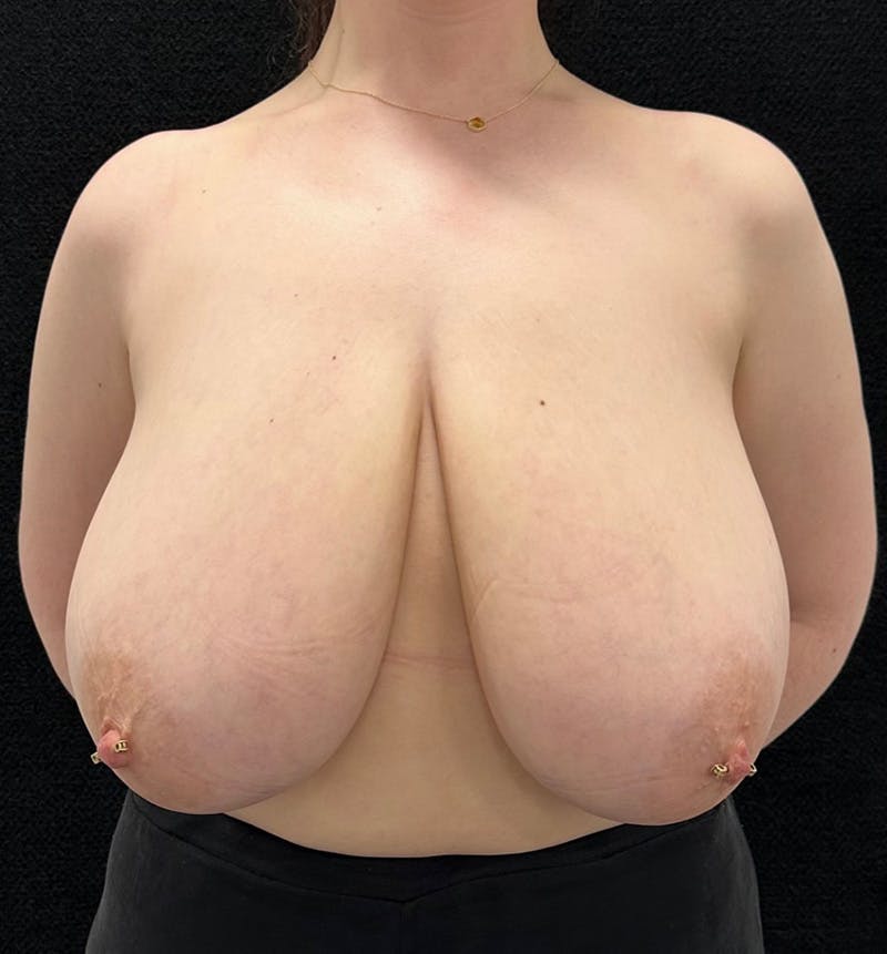 Breast Reduction Before & After Gallery - Patient 392917 - Image 1