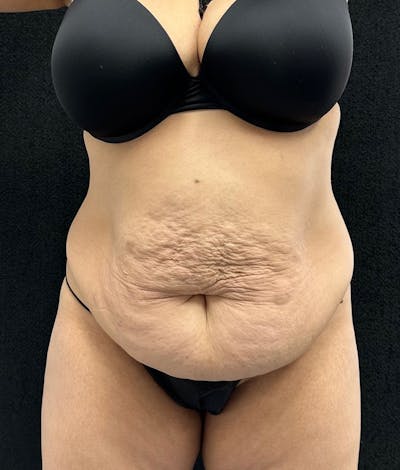 Lower Body Lift Before & After Gallery - Patient 315606 - Image 1