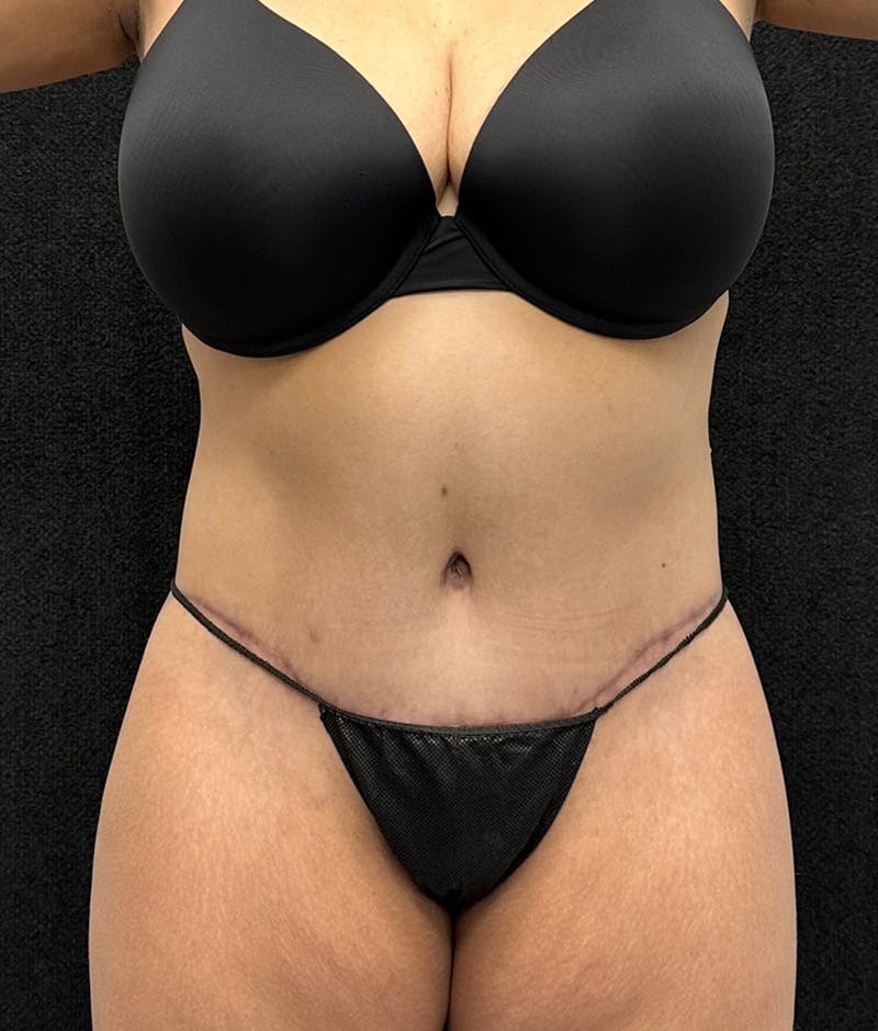 Lower Body Lift Before & After Gallery - Patient 315606 - Image 2
