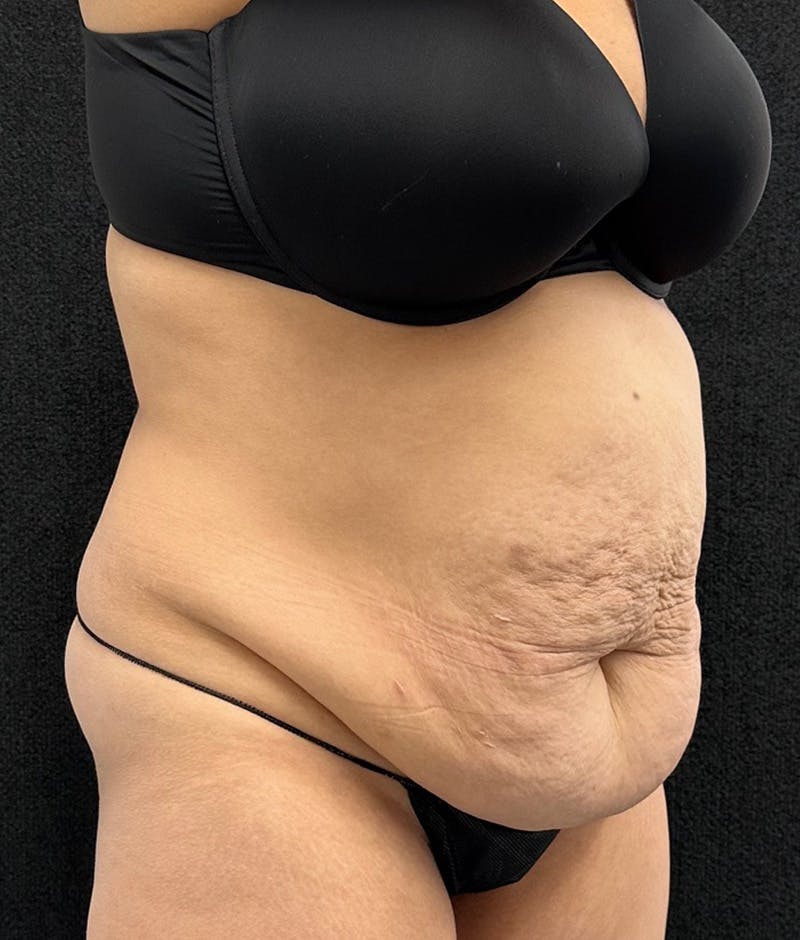 Lower Body Lift Before & After Gallery - Patient 315606 - Image 3