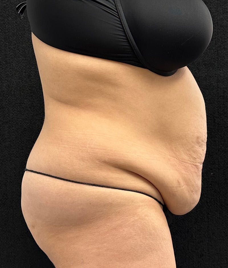 Lower Body Lift Before & After Gallery - Patient 315606 - Image 5