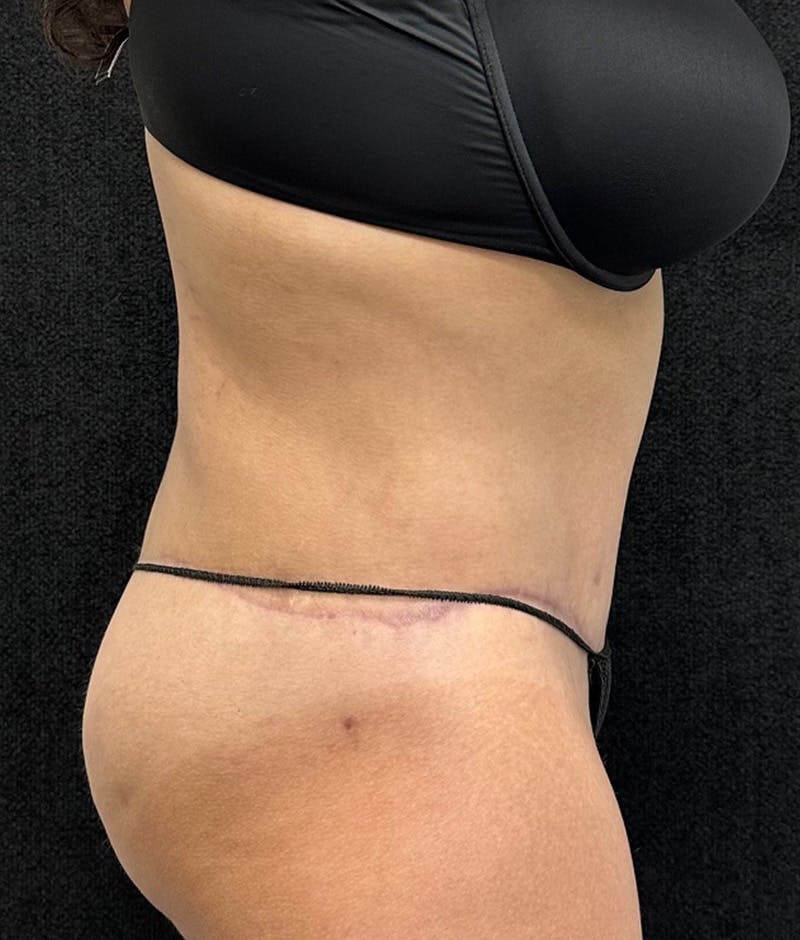 Lower Body Lift Before & After Gallery - Patient 315606 - Image 6