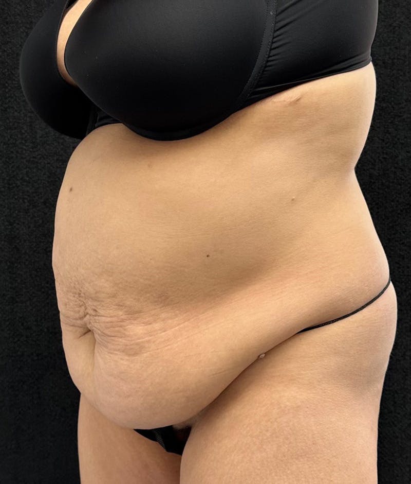 Lower Body Lift Before & After Gallery - Patient 315606 - Image 7