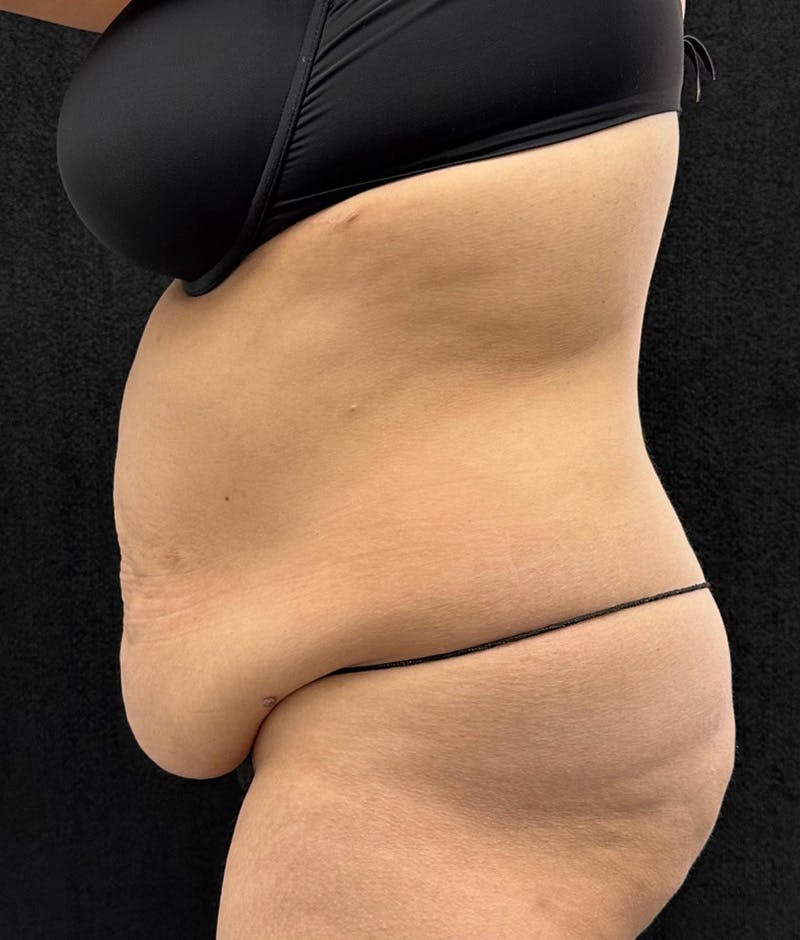 Lower Body Lift Before & After Gallery - Patient 315606 - Image 9
