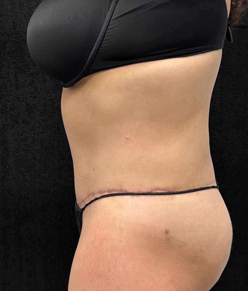 Lower Body Lift Before & After Gallery - Patient 315606 - Image 10