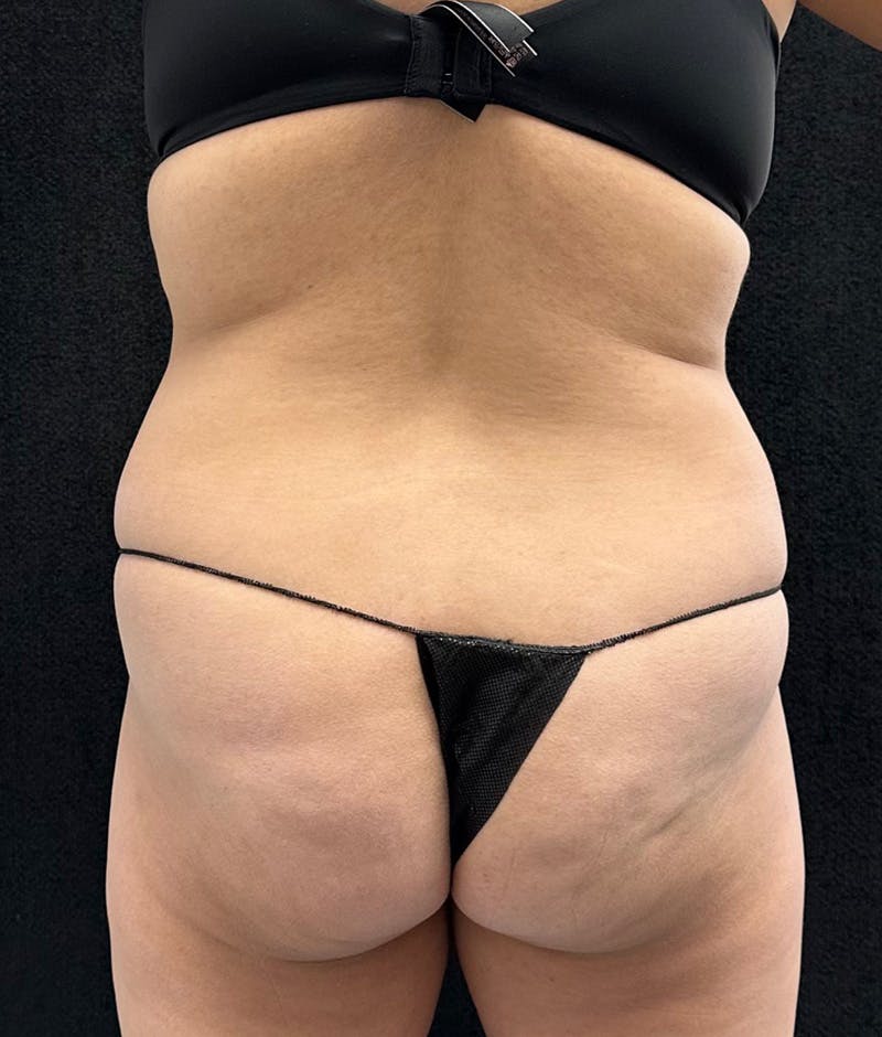 Lower Body Lift Before & After Gallery - Patient 315606 - Image 11